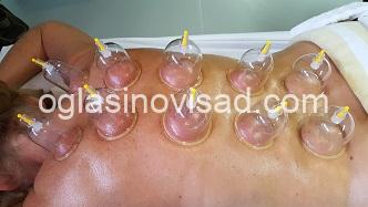cupping-20180126_122614